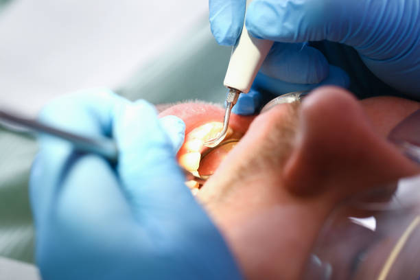 Best Knocked-Out Tooth (Avulsed Tooth) Treatment in Rome, GA